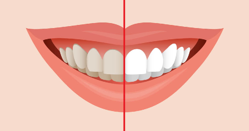 عکس گرافیکی دندان های سفید در مقابل دندان های کثیف و لکه دار